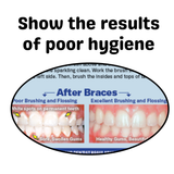 Flossing & Brushing With Braces