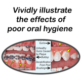 Preventing Problems With Braces