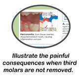 Third Molar Evaluation