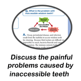 Third Molar Evaluation