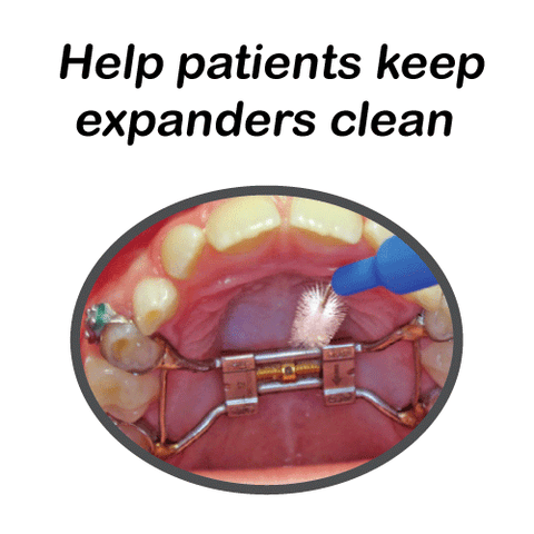 https://oneilpracticeresources.com/cdn/shop/products/New-PEG-keep-expanders-clean_large.png?v=1519235921