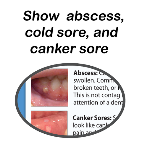 Tooth Abscess Vs Canker Sore: Spot the Difference