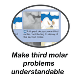Third Molar Evaluation